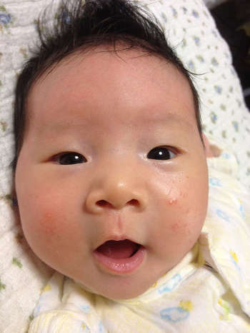 赤ちゃんニキビ